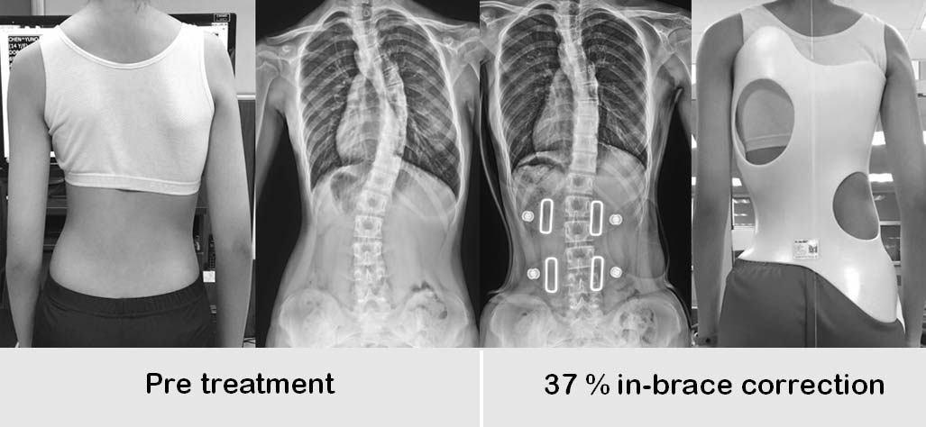 脊椎側彎，脊椎側彎矯正，脊椎側彎背架