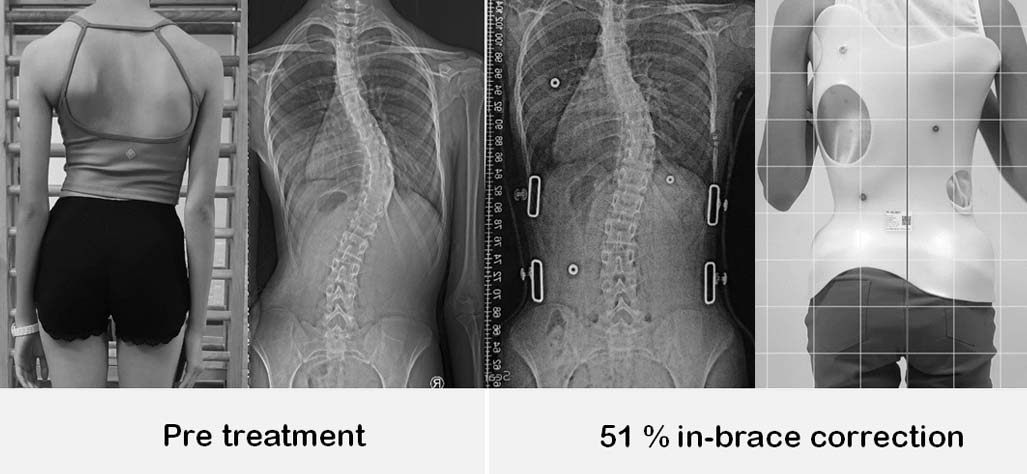 脊椎側彎，脊椎側彎矯正，脊椎側彎背架