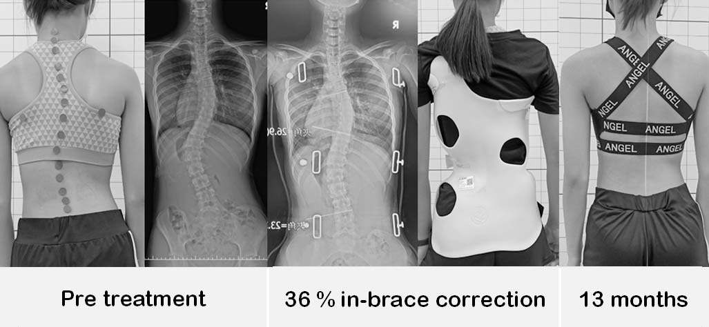 脊椎側彎，脊椎側彎矯正，脊椎側彎背架