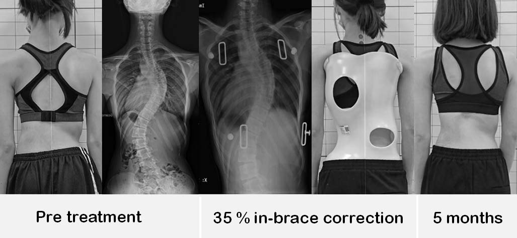 脊椎側彎，脊椎側彎矯正，脊椎側彎背架