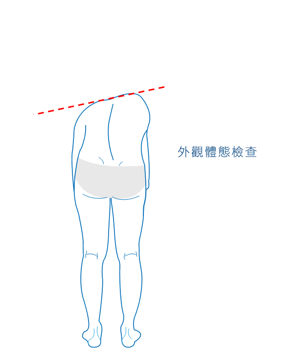 脊椎側彎，亞當測試