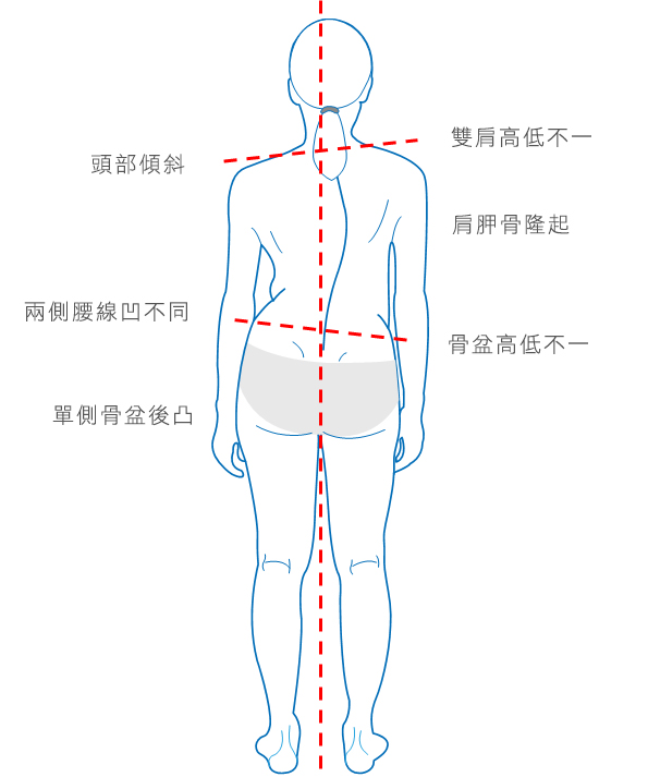 脊椎側彎